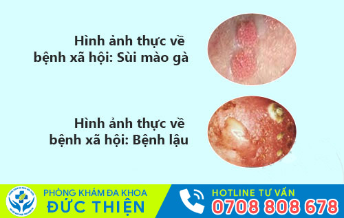 Hình ảnh bệnh sùi mào gà, bệnh lậu