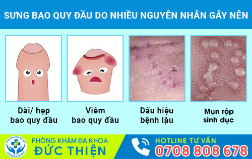 Sưng bao quy đầu do nhiều nguyên nhân gây nên