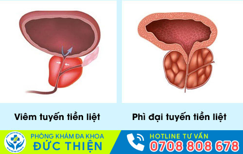 Bệnh về tuyến tiền liệt
