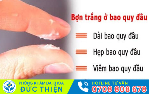 Viêm bao quy đầu làm xuất hiện các bợn trắng