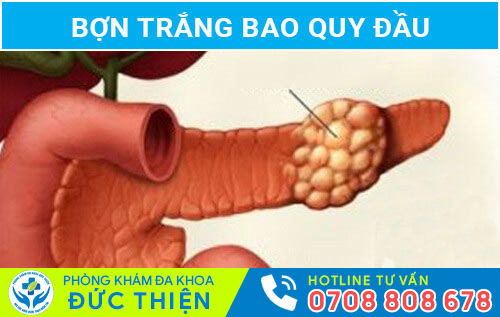 Hình ảnh bợn trắng bao quy đầu