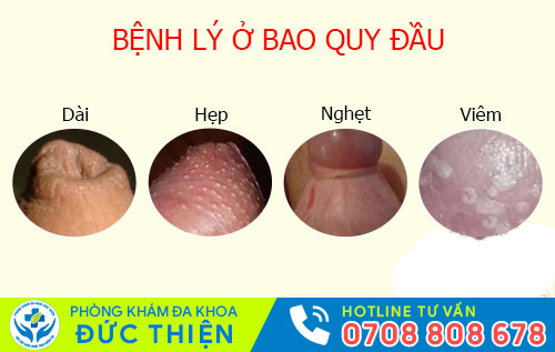 Tình trạng bất thường cảnh báo bệnh lý ở bao quy đầu
