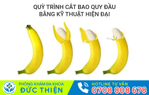 Quy trình cắt bao quy đầu