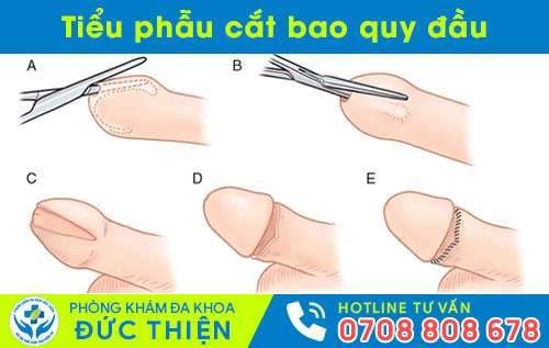 Tiểu phẫu cắt bao quy đầu
