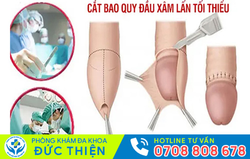Cắt bao quy đầu xâm lấn tối thiểu hiện đại hiệu quả vượt trội