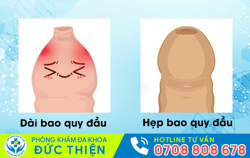 Dài bao quy đầu và hẹp bao quy đầu