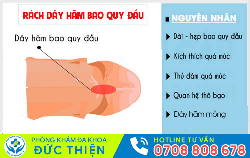 Có nên cắt dây hãm bao quy đầu?