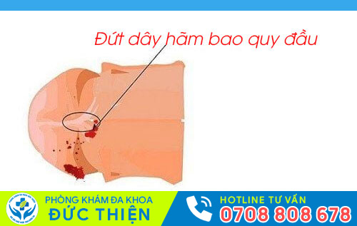 Đứt dây hãm bao quy đầu