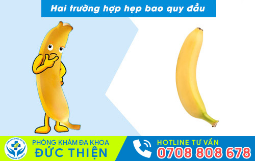Hai dạng hẹp bao quy đầu