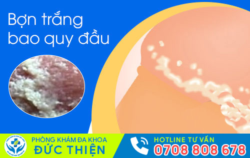 Hình ảnh bợn trắng bao quy đầu