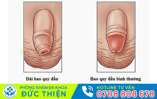 Hình ảnh dài bao quy đầu