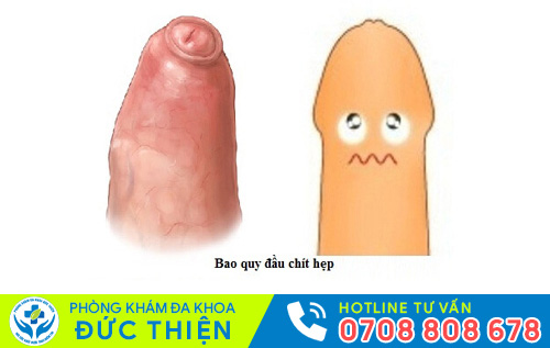 Hình ảnh hẹp bao quy đầu ở người lớn