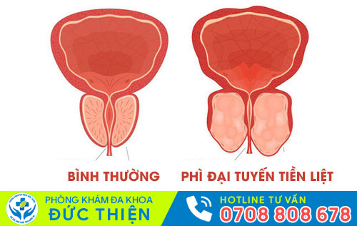Hình ảnh phì đại tuyến tiền liệt