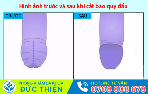 Hình ảnh trước và sau khi cắt bao quy đầu