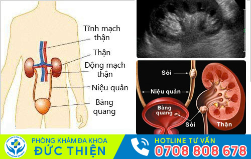 Siêu âm hệ tiết niệu trong gói khám sàng lọc bệnh tiết niệu