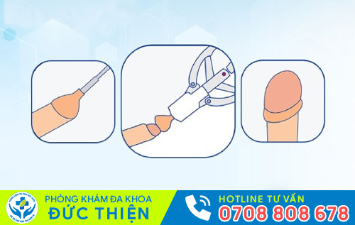 Cắt bao quy đầu