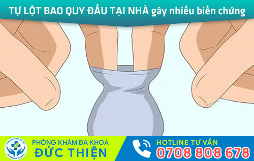 Tự lột bao quy đầu tại nhà gây nhiều biến chứng nguy hiểm