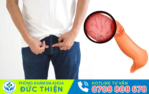 Nấm bao quy đầu ở nam giới