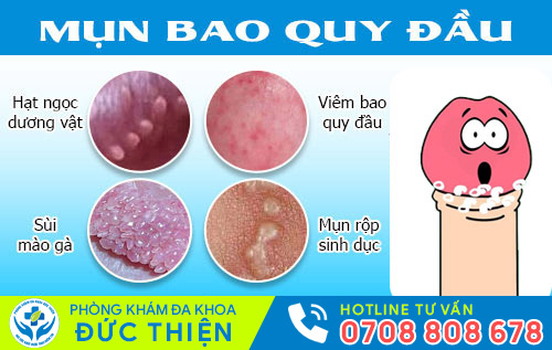 Hình ảnh nổi mụn bao quy đầu