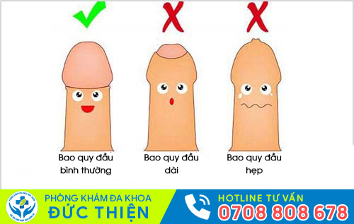 Các dạng bệnh lý cần cắt da bao quy đầu
