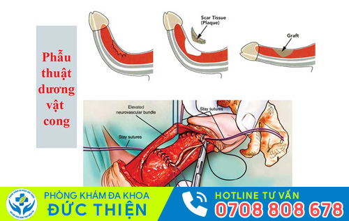 Biến chứng cong dương vật do kỹ thuật khâu không đúng cách