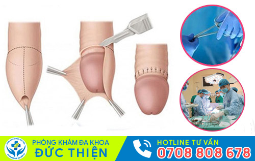 Phương pháp hỗ trợ điều trị đau buốt quy đầu hiệu quả