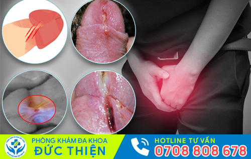 Hình ảnh rách bao quy đầu