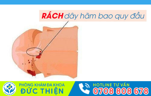 Rách dây hãm bao quy đầu