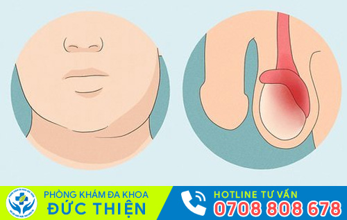 Sưng tinh hoàn bên trái là dấu hiệu nhiều bệnh nguy hiểm