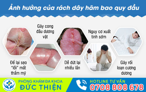 Ảnh hưởng của rách dây hãm bao quy đầu
