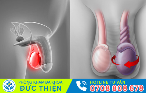 Nhiều tác hại nguy hiểm khi bị sưng tinh hoàn trái