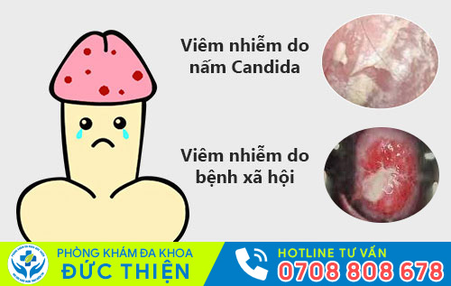 Viêm nhiễm do nấm Candida, bệnh xã hội