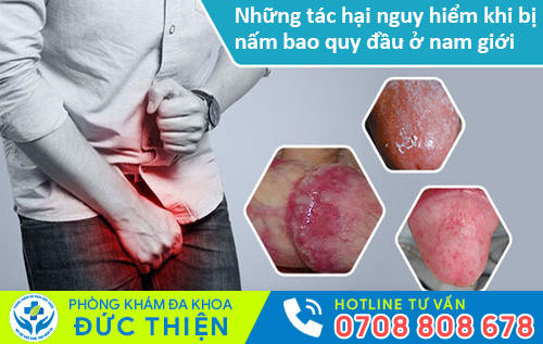 Những tác hại nguy hiểm khi bị nấm bao quy đầu ở nam giới