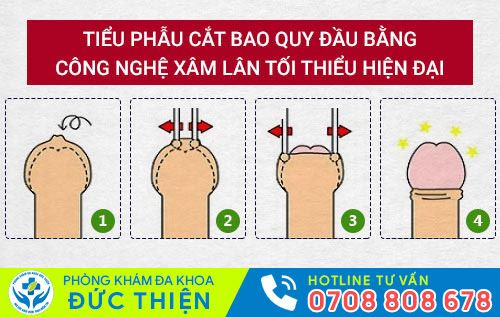 Cắt bao quy đầu giúp kéo dài thời gian quan hệ