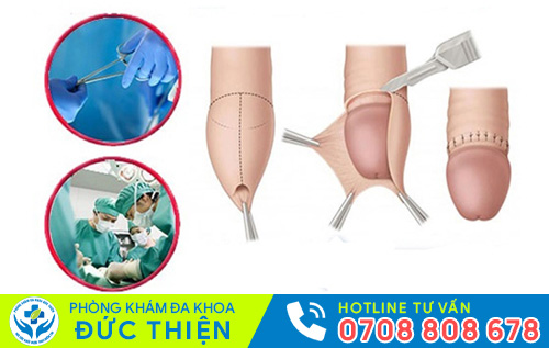 Tiểu phẫu thông nối cắt bao quy đầu tự hào là kỹ thuật tốt và hiện đại
