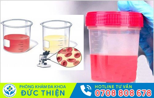 Tiểu ra máu đại thể và vi thể ở nam giới