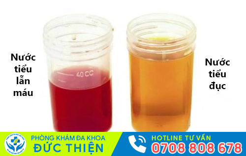Nước tiểu đục, có lẫn máu là triệu chứng viêm đường tiết niệu ở nam và nữ