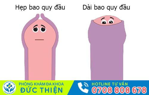 Phân biệt dài/hẹp bao quy đầu