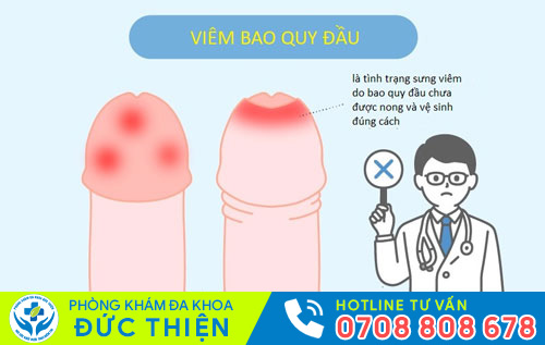 Viêm bao quy đầu gây lở loét bao quy đầu
