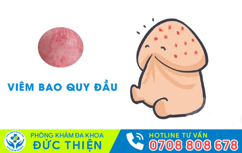 Đau buốt quy đầu do viêm bao quy đầu