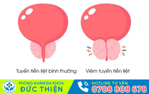 Viêm tuyến tiền liệt