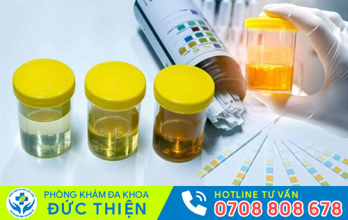 Xét nghiệm nước tiểu giúp phát hiện nhiều bệnh