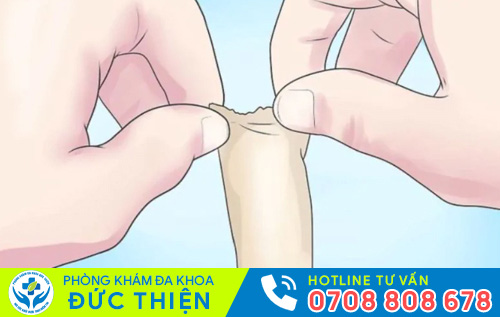 Xử lý rách bao quy đầu sớm phòng tránh nhiều biến chứng nguy hiểm