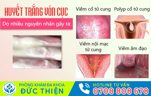 Nguyên nhân huyết trắng vón cục