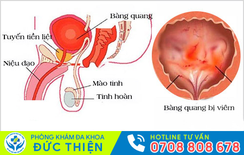 Bệnh viêm bàng quang cấp