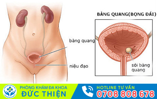 Biểu hiện bệnh sỏi bàng quang