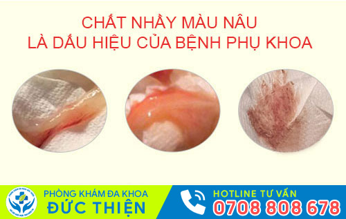 Chấy nhầy màu nâu là dấu hiệu của bệnh phụ khoa