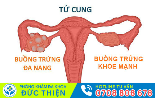 đa năng buồng trứng