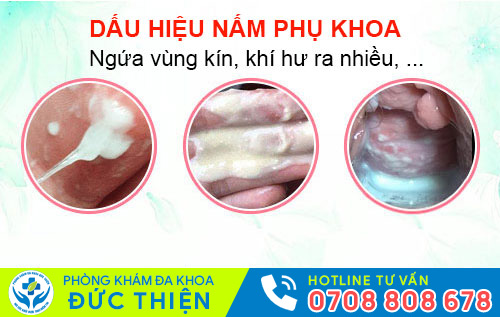 Dấu hiệu nấm phụ khoa