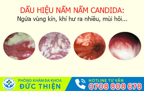 Dấu hiệu nhiễm nấm candida